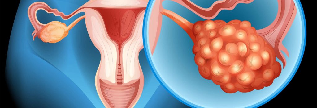 Uterine Fibroids Treatment In Hyderabad_ Hystrectumi_ IVYHealthcare